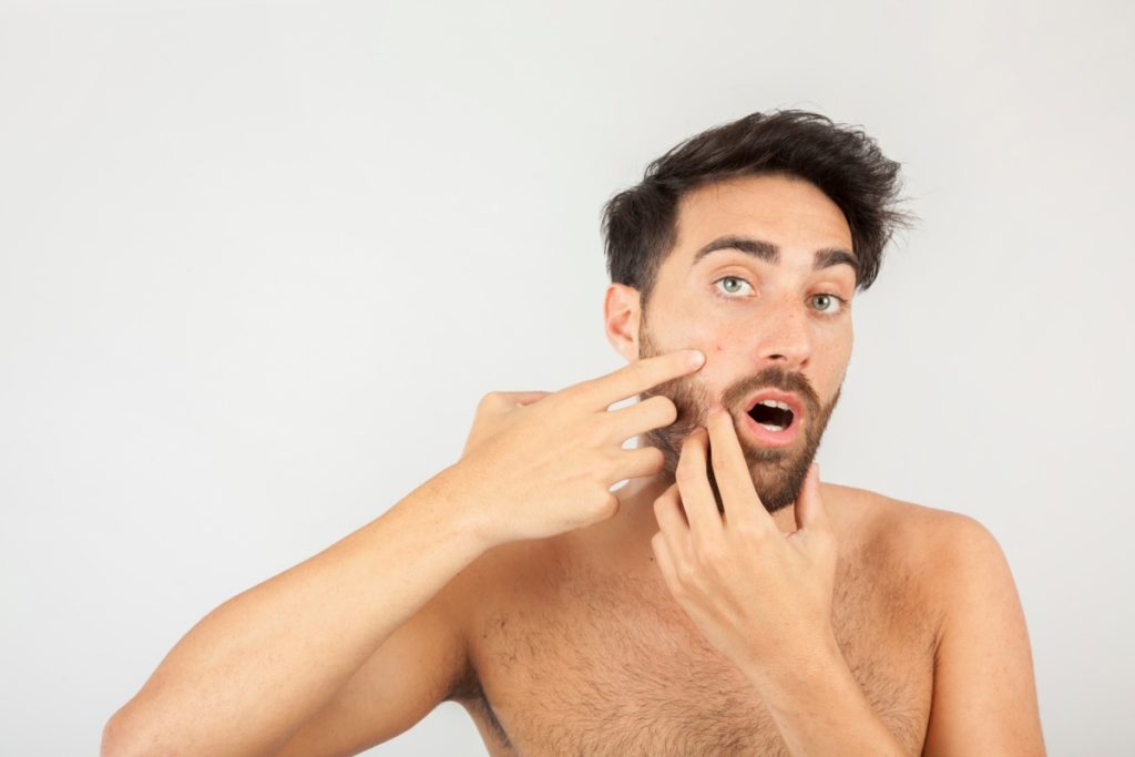 man with adult acne